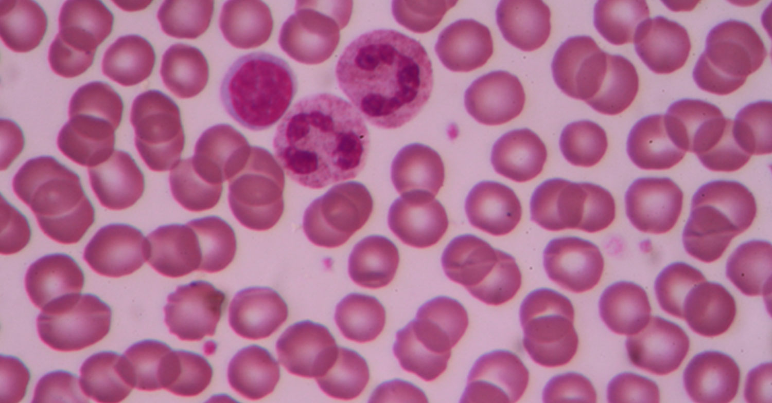 I genitori di una minorenne, affetta da leucemia, condannati ...