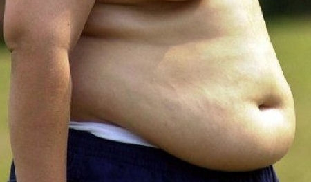 Obeso muore dopo intervento by pass bilio-intestinale. Omicid...