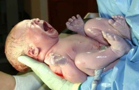 Un neonato durante il travaglio subisce lesioni cerebrali. Pe...